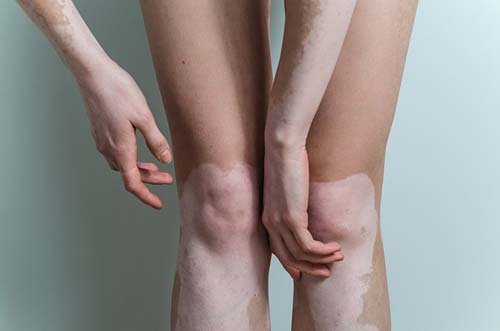 vitiligo traitement naturel
